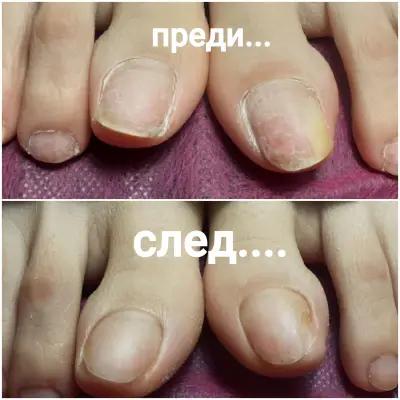 Медицински педикюр - гр.Ямбол Pedi-Cure