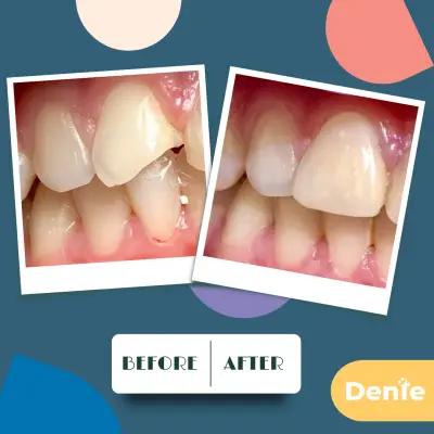 Dente