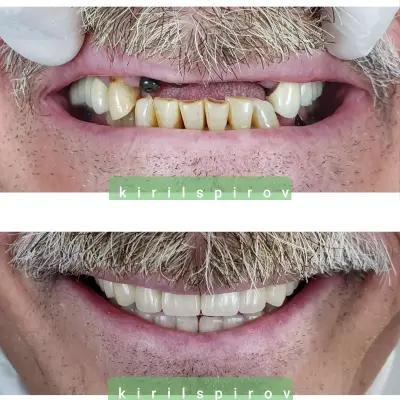 СПИРОВИ ДЕНТАЛНИ УСЛУГИ spirovi dental services