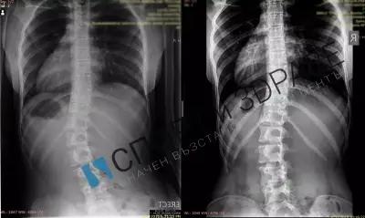 Сколио БГ - Спорт и здраве - център по сколиоза и гръбначни състояния