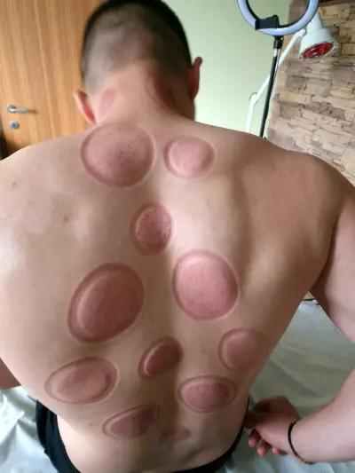 AY STAR Hijama